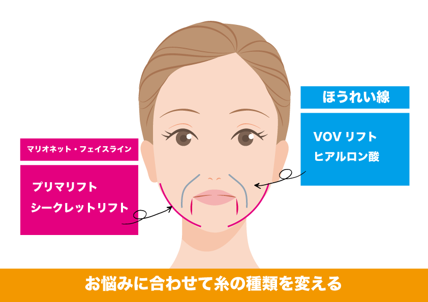 糸の種類について